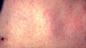 San Diego County health officials urge caution around measles on spring break – NBC 7 San Diego