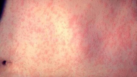 San Diego County health officials urge caution around measles on spring break – NBC 7 San Diego
